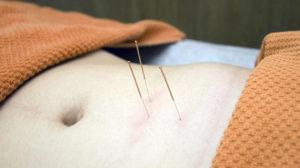 quality acupuncture