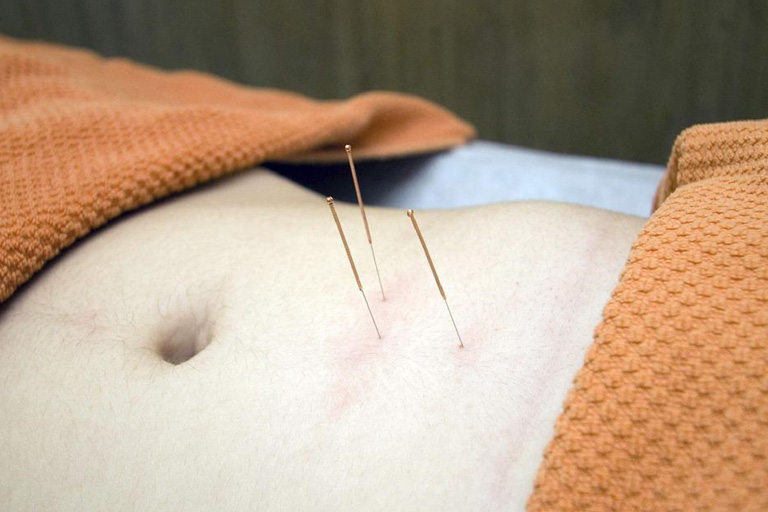 quality acupuncture