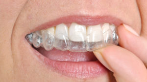 Benefits of Using Invisalign Clear Braces