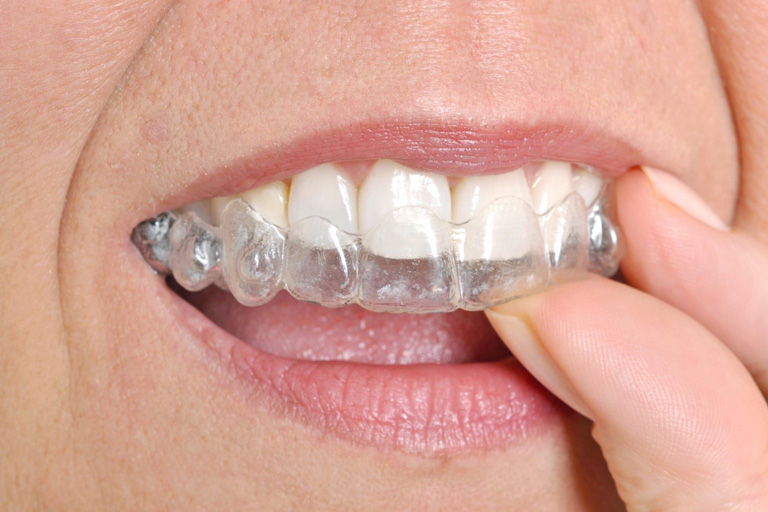 Benefits of Using Invisalign Clear Braces