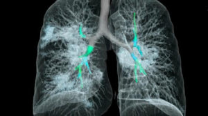 Vendors debut AI X-ray system for COVID-19, give it away for free