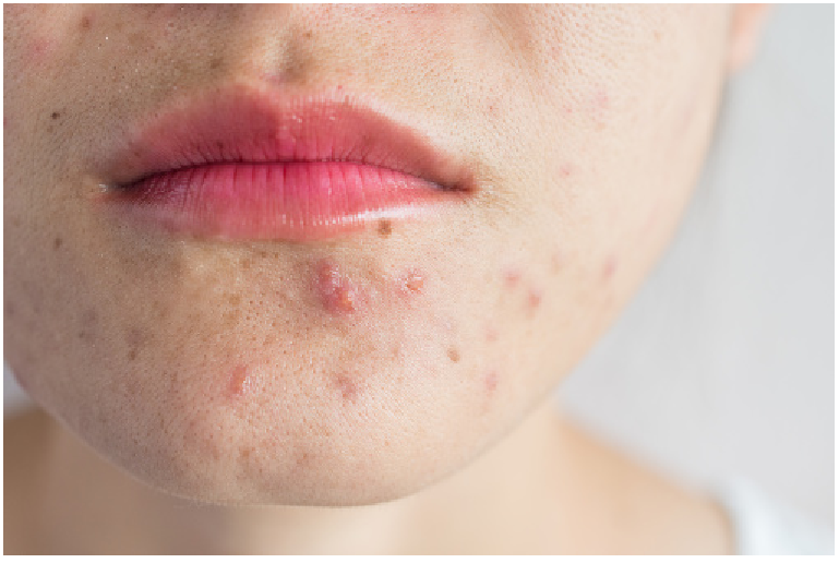 7 Effective Substances for Acne Treatment