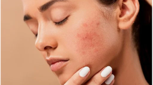 7 Effective Substances for Acne Treatment