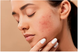 7 Effective Substances for Acne Treatment