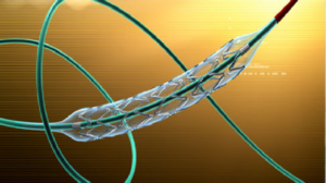 neurovascular disease