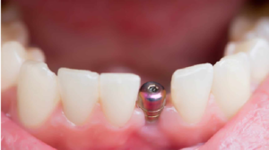 dental implant