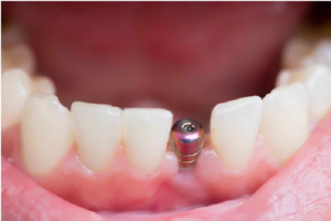 dental implant