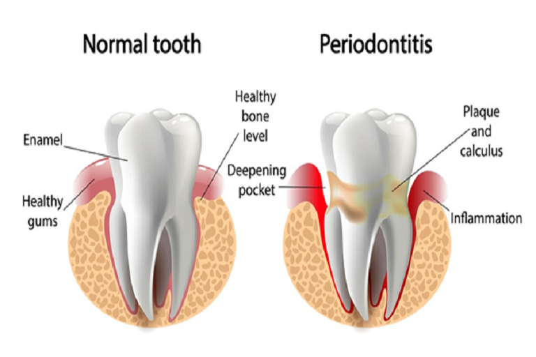 periodontal care