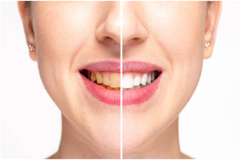 teeth whitening