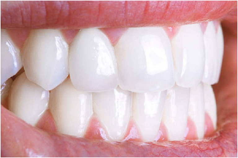 teeth whitening