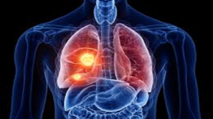 small cell lung cancer