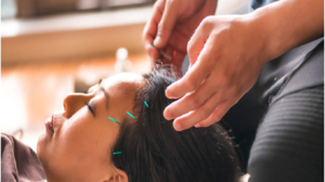 acupuncture and cupping