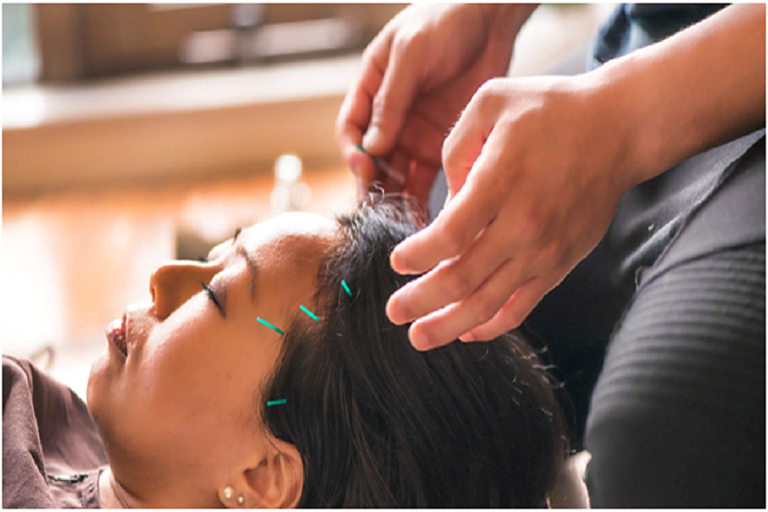 acupuncture and cupping