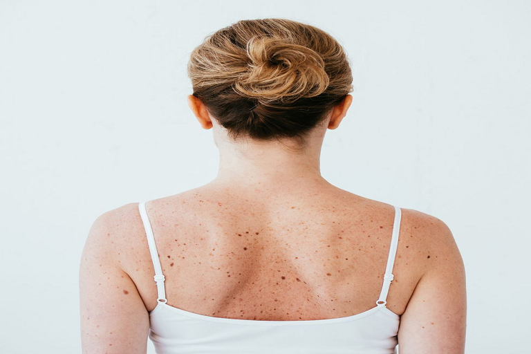 skin cancer