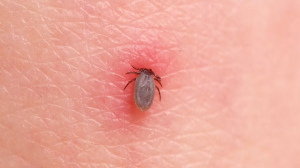 tick bite treatment