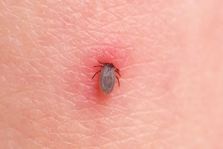 tick bite treatment