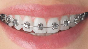 orthodontic treatment