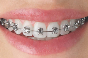 orthodontic treatment