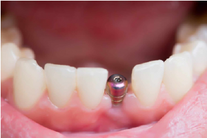 dental implant techniques