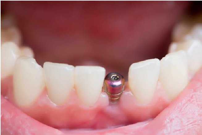 dental implant techniques