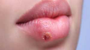 cold sores