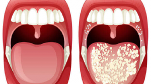 candidiasis of the mouth