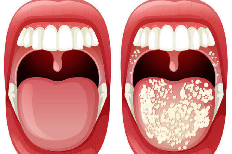 candidiasis of the mouth