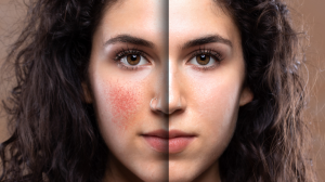 rosacea